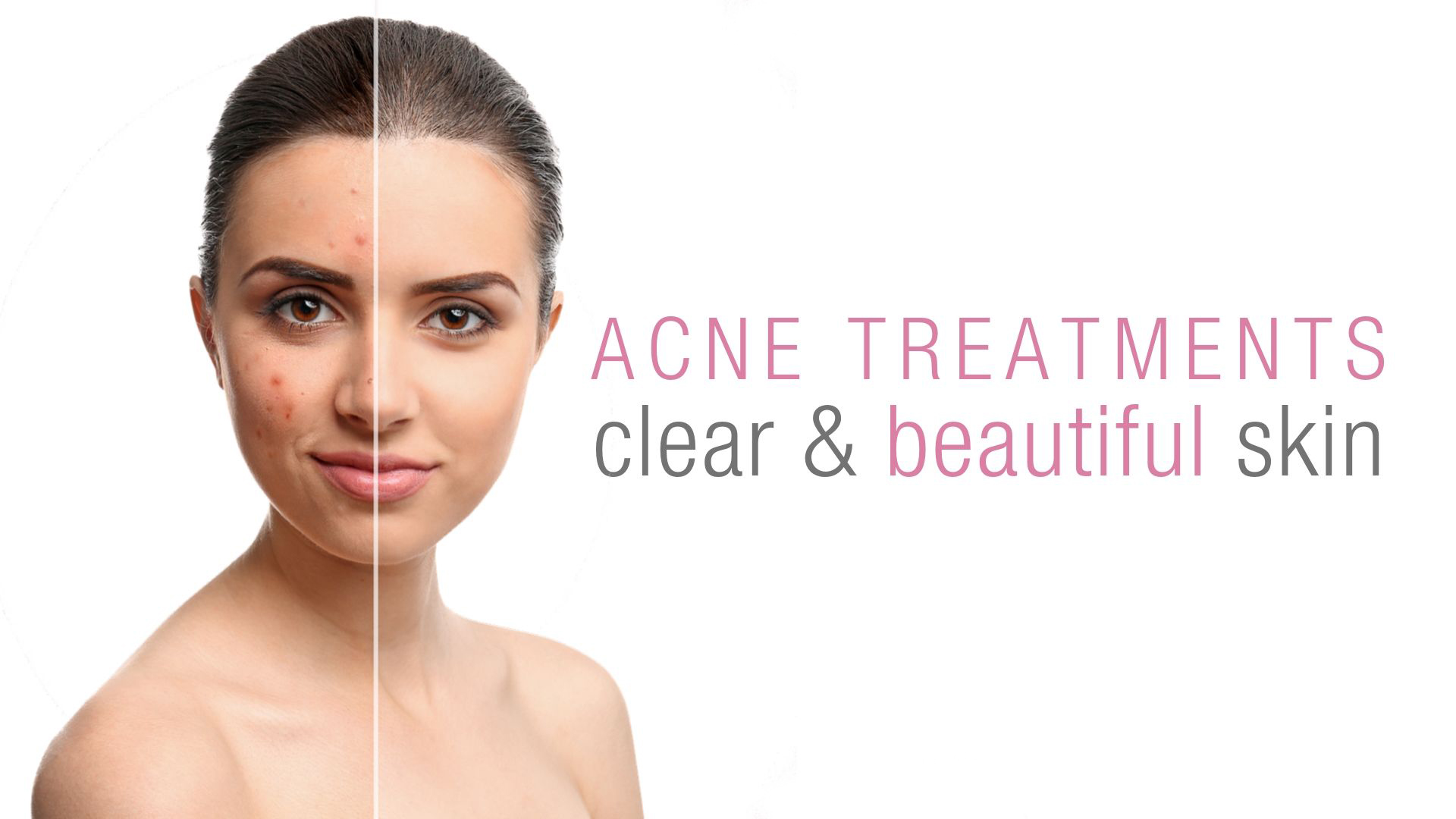 acne treatment dubai