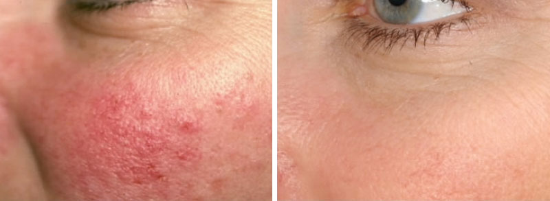 Rosacea Treatment dubai